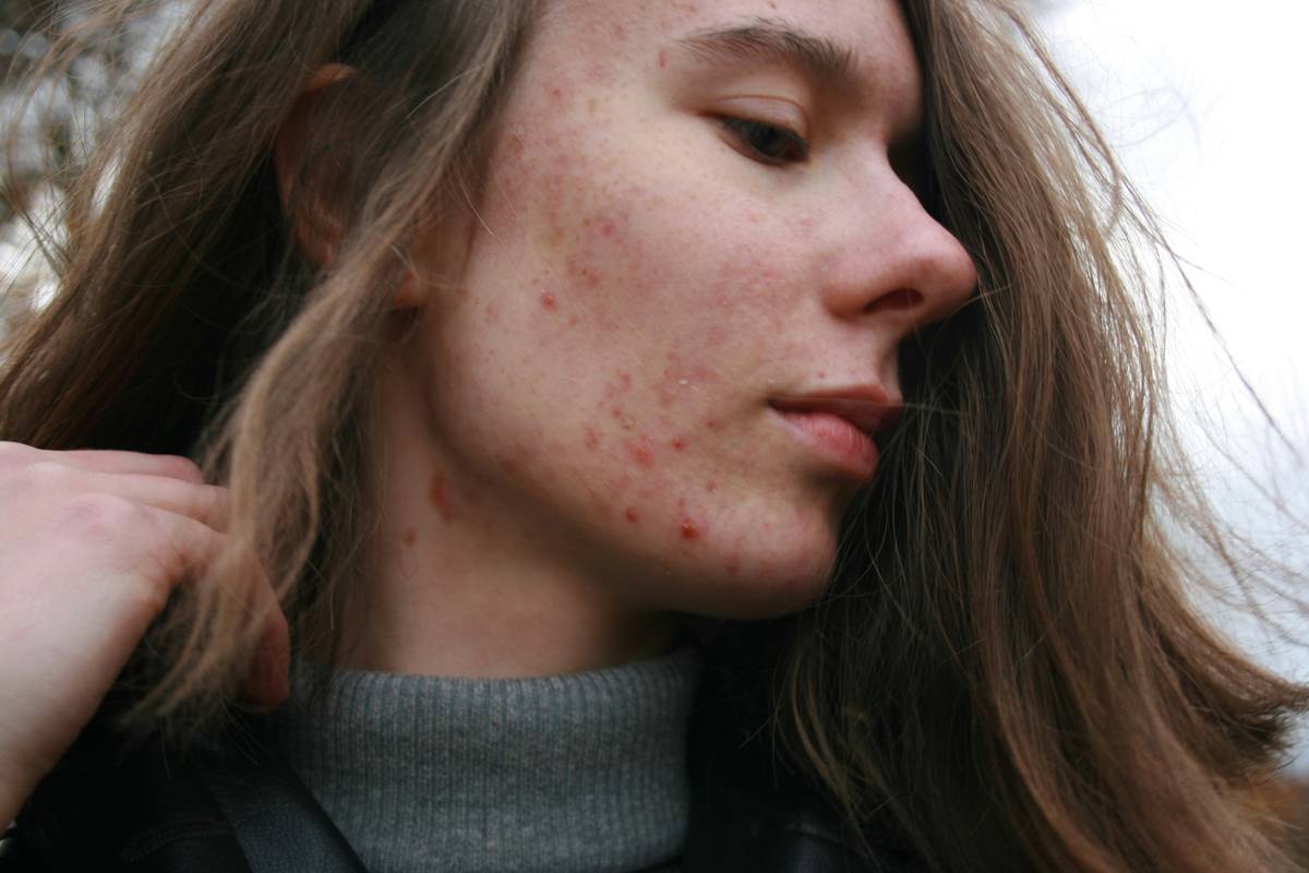 woman applying witch hazel for acne skin with cotton pad on clean face